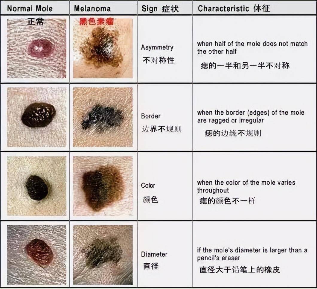 儿童脸上的痣图 图解图片