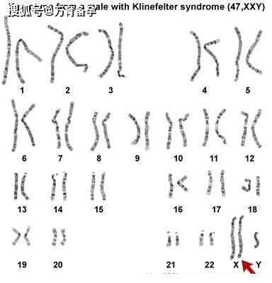 正常染色体报告单图片图片