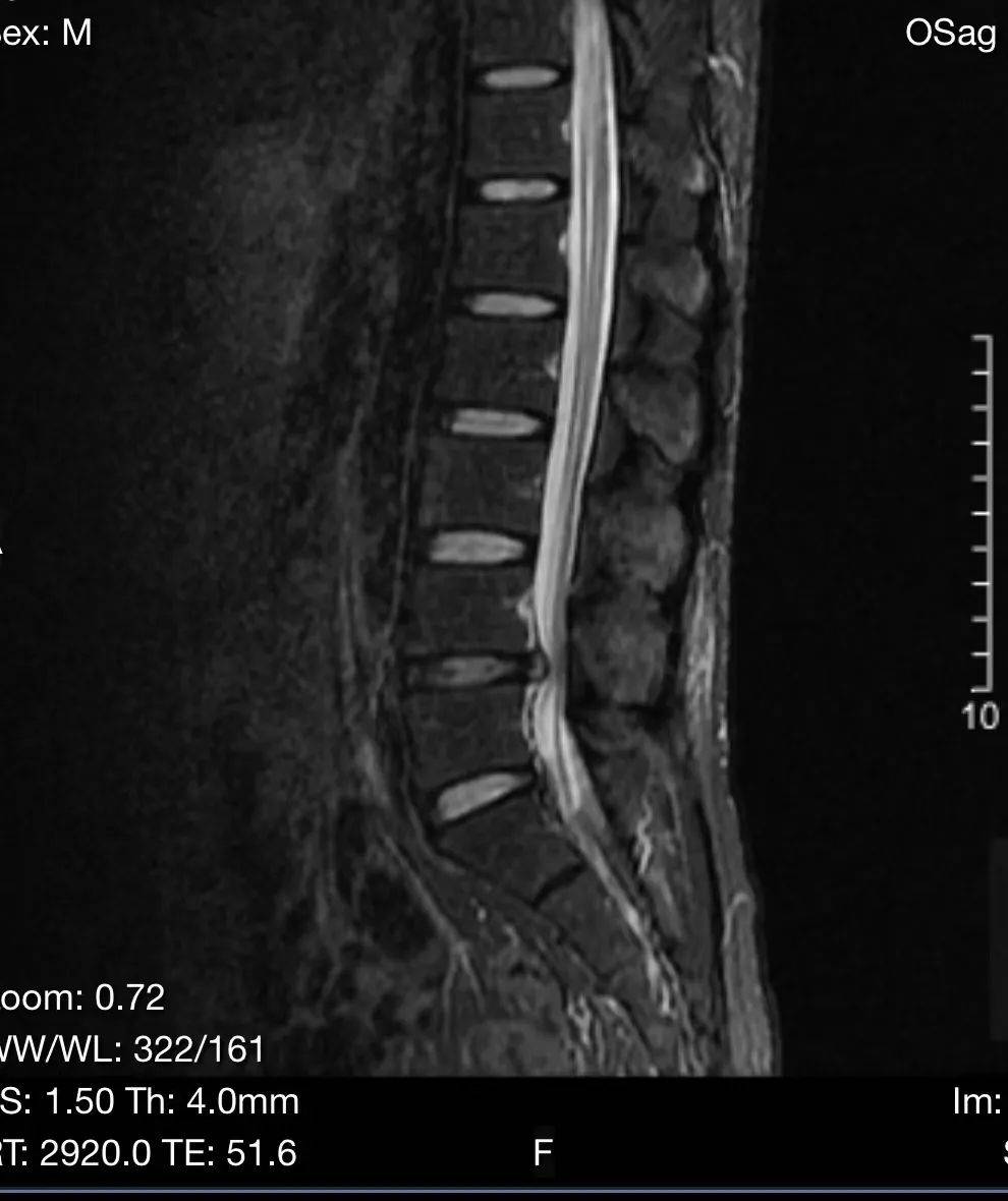 腰突后,感觉腿上长了蚂蚁窝,一只两只.爬过难受无比!