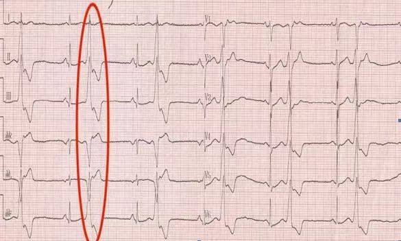 多源性室早心电图图片图片