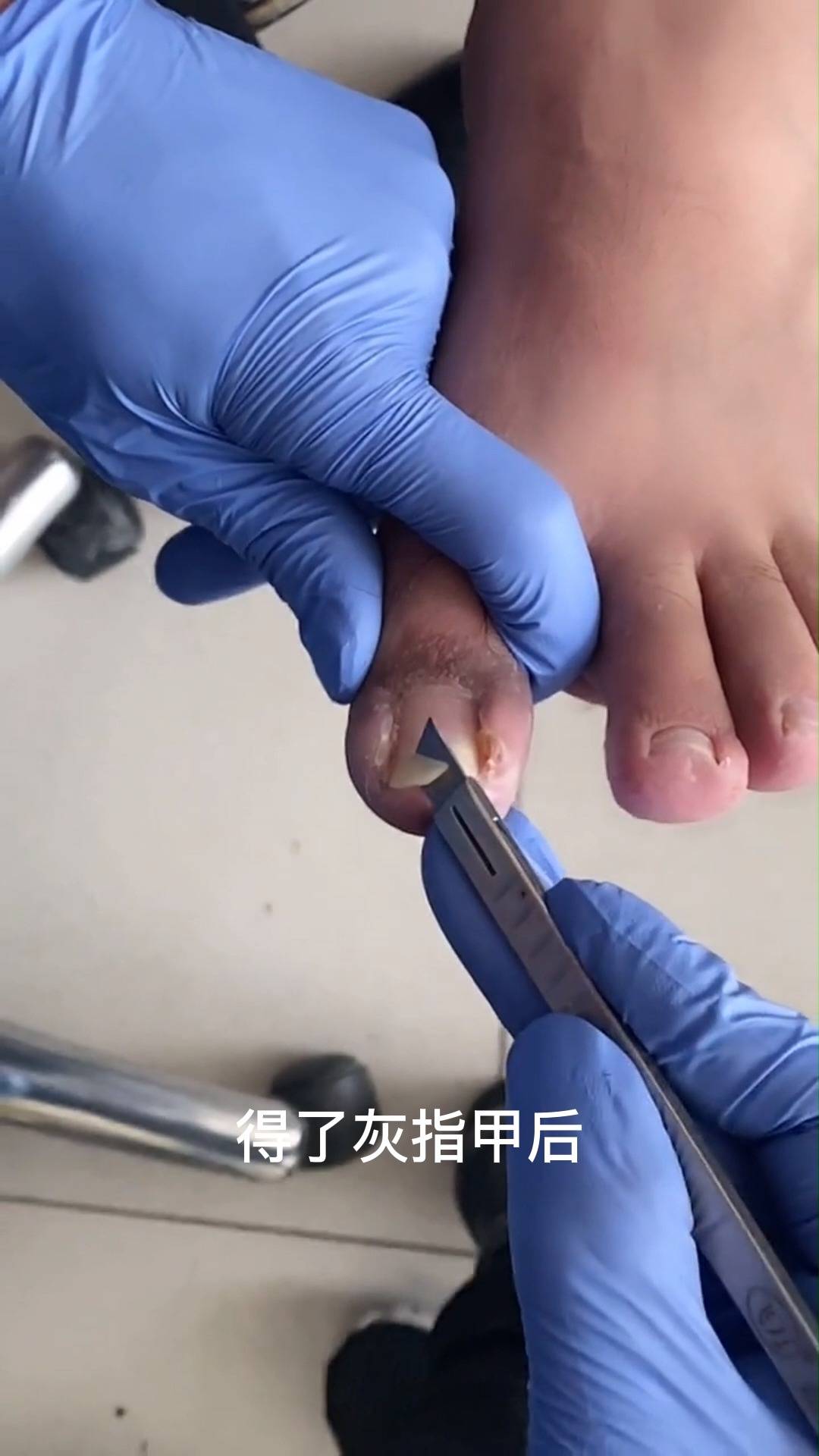 修腳灰指甲甲溝炎嵌甲腳趾甲發黃長到肉裡怎麼辦30變好甲