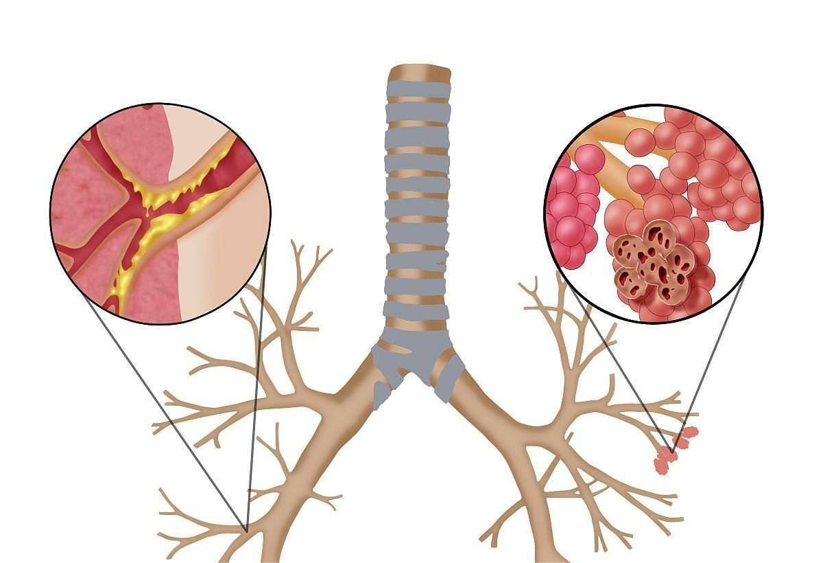 知識分享慢阻肺和肺氣腫作為慢性病居家理療不容忽視