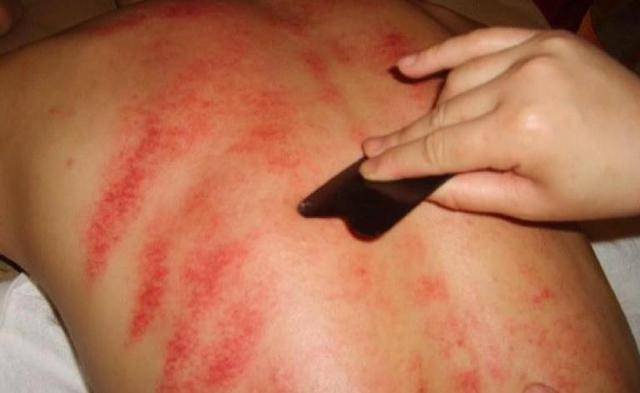 原创刮痧究竟是真养生还是伪科学刮痧刮出来的痧到底是啥