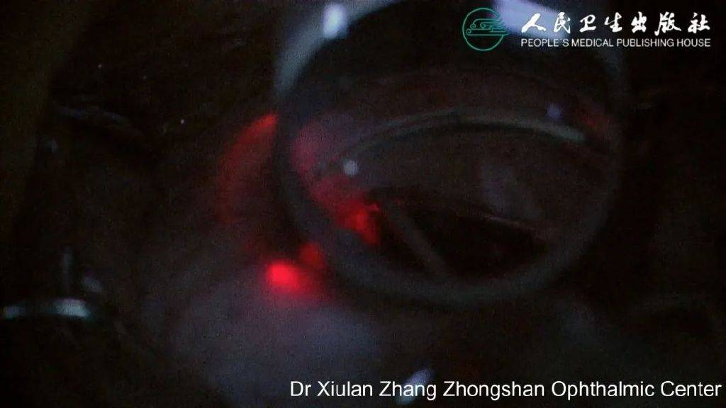 青光眼微创治疗术式:房角镜辅助的 360 度小梁切开术_导管_手术_患者
