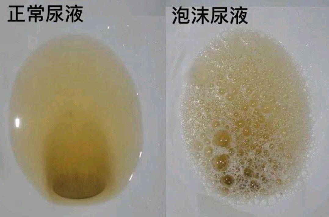 4,尿液中有泡沫男性患前列腺炎,女性患尿路感染,排尿疼痛.