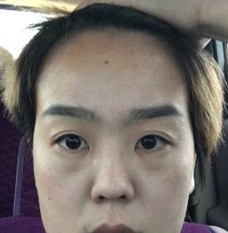 日月角有疤痕,父母有一方身体较差或事业受阻,福德宫塌陷,容易很早就