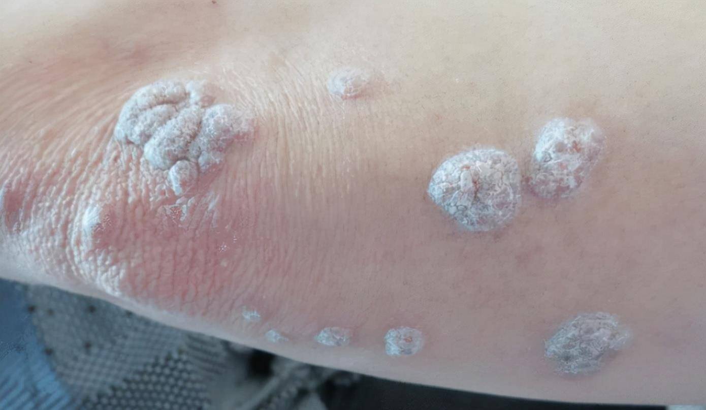 宫颈病变,大腿会发出"信号灯",若双腿出现2个症状,建议尽早查hpv_女性