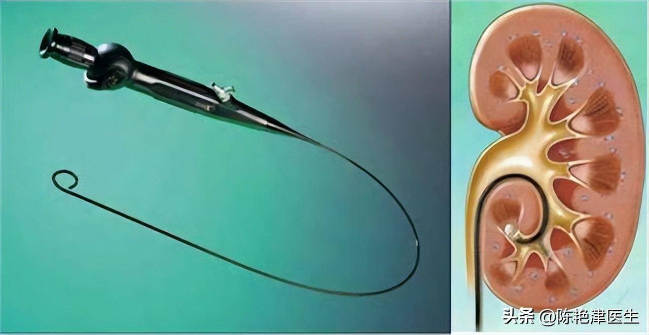 做了b超,ct,mri的检查过后,发现了双肾结石伴肾积水,不及时处理的话