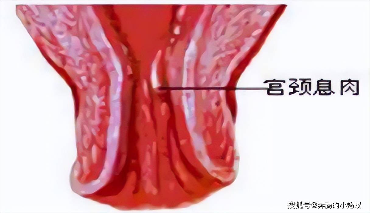 外阴舌状息肉图片