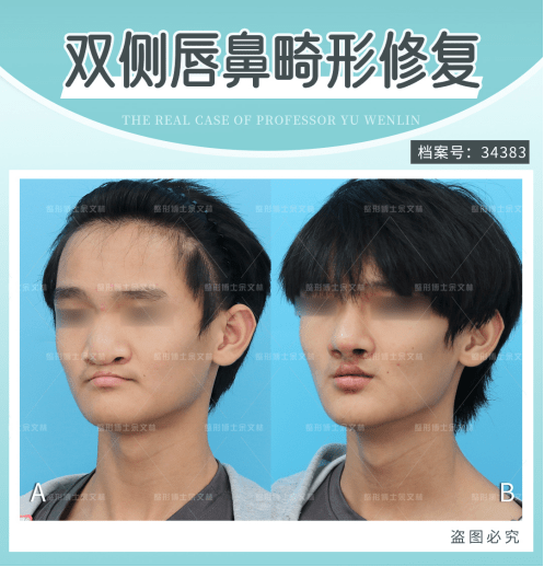 【案例分析】从"牛鼻子"到小翘鼻,其中的心酸只有他知道!