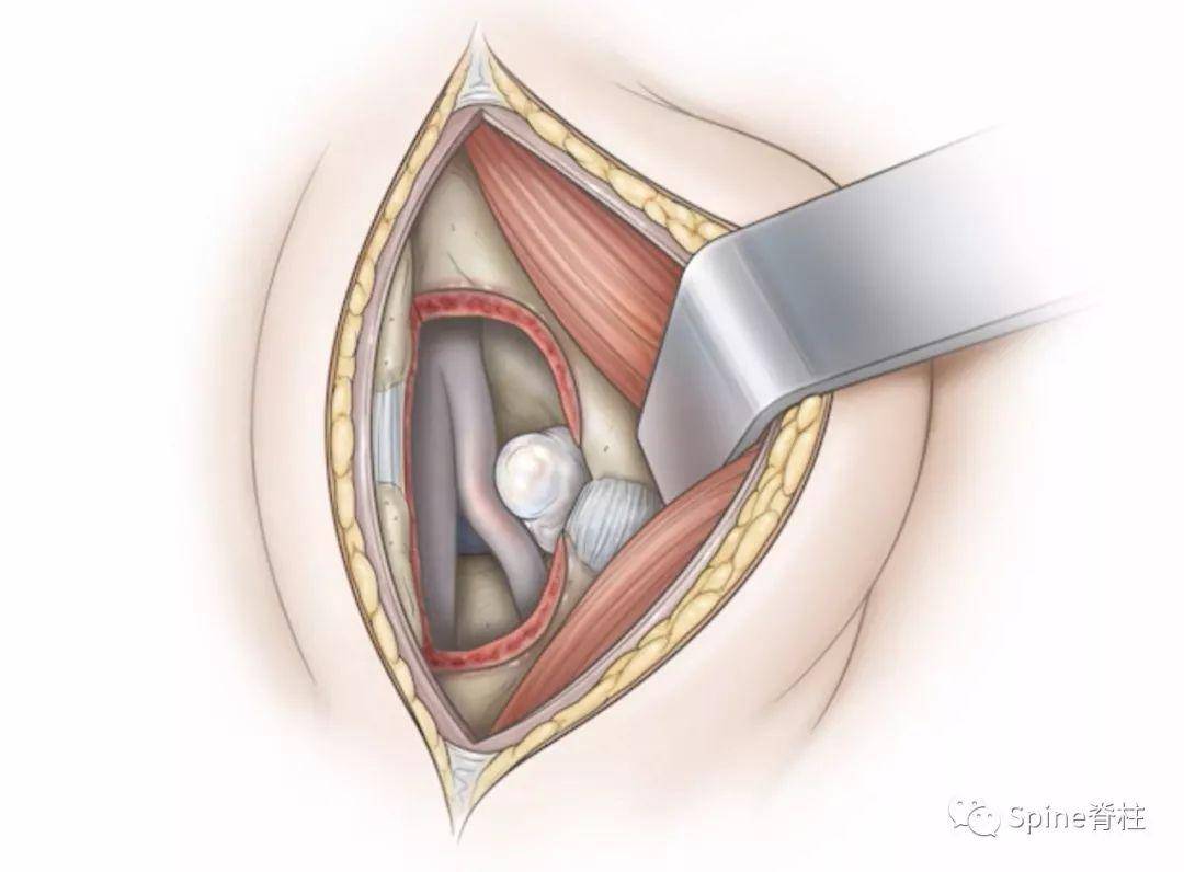 圖:顯微鏡下腰椎間盤切除術(microdiskectomy)術中體位及切口位置