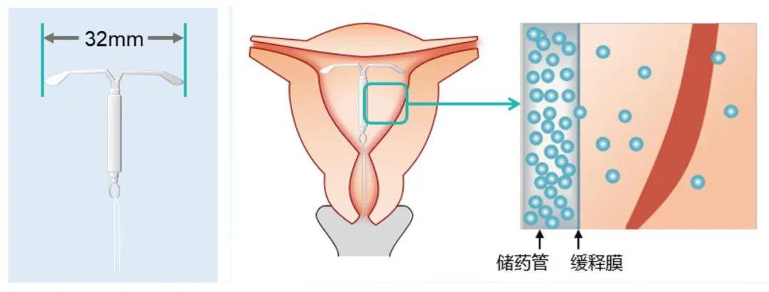 曼月樂能避孕更能治病_子宮_內膜_樂環