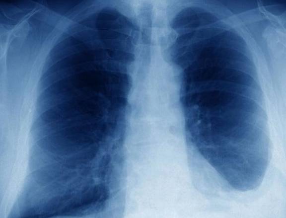 慢阻肺有哪些症状？诊断慢阻肺需要进行什么检查？小克告诉你