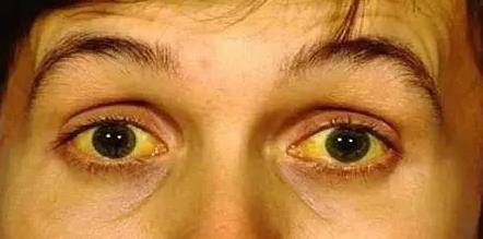 若是突然出现眼睛和脸部皮肤发黄,很大可能是患上了急性黄疸型肝炎