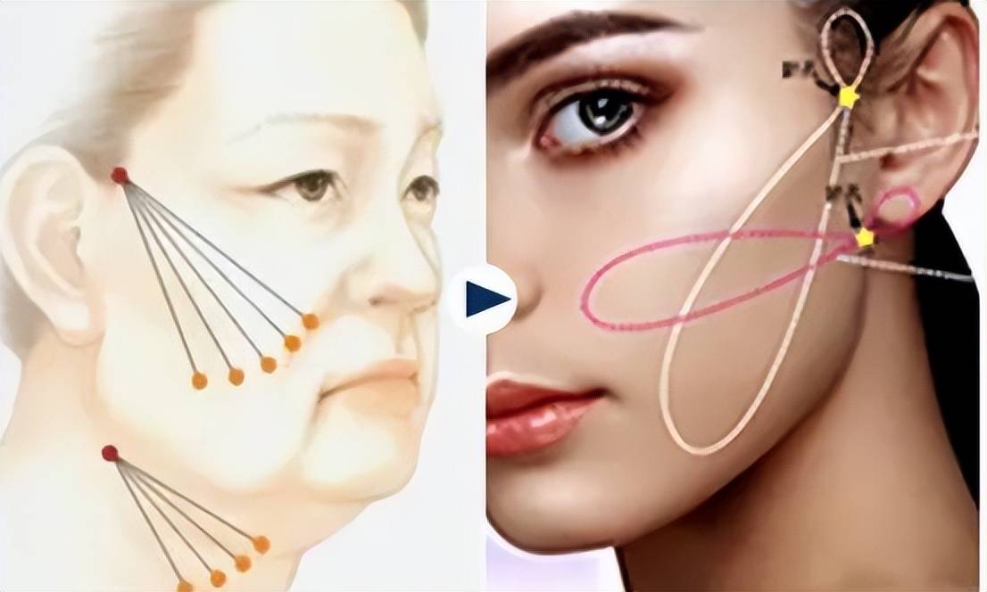 解说:悦升线是线雕最好的吗?悦升线提升苹果肌复位咋样?