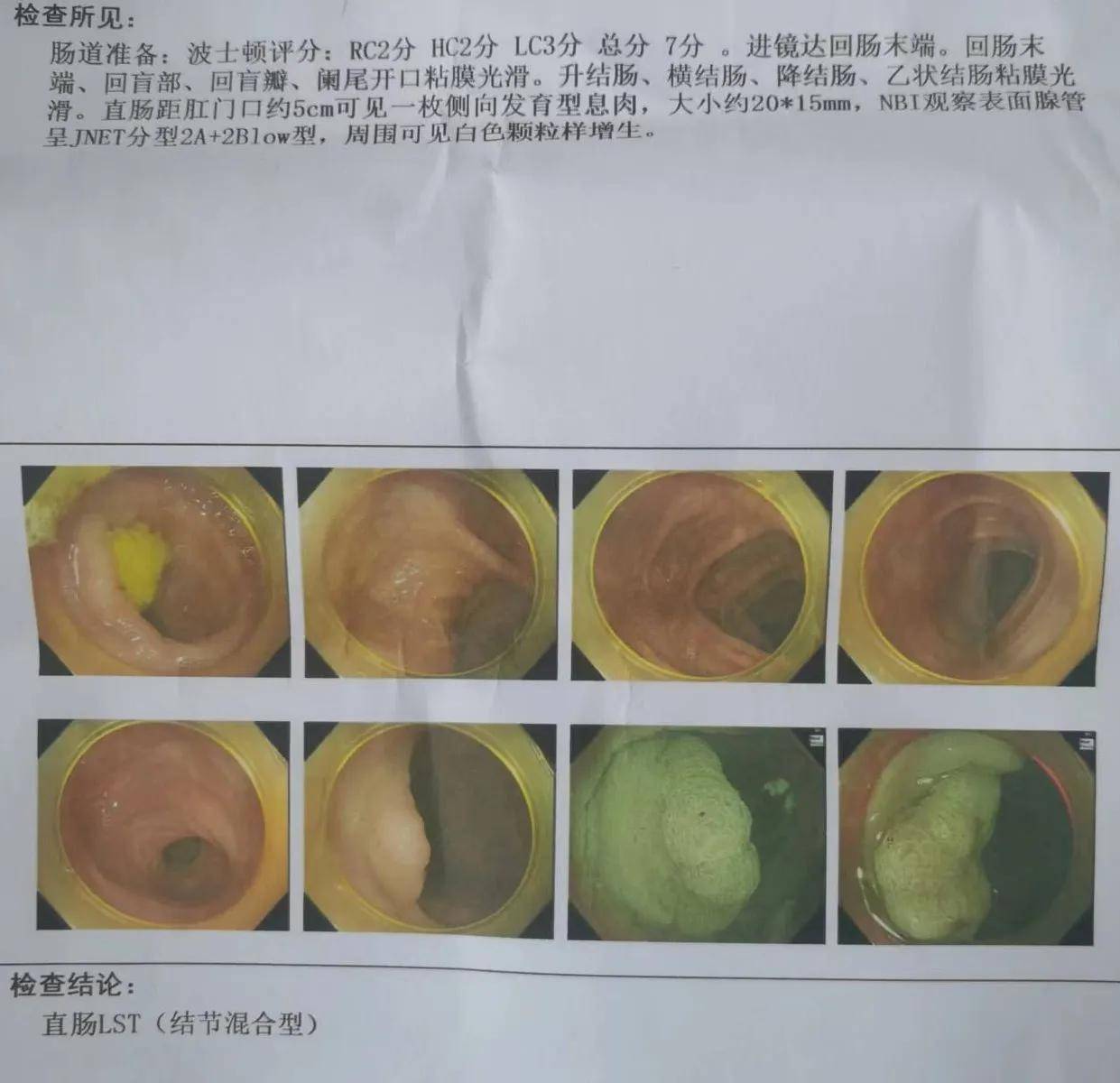 2022年7月7日的肠镜报告单凝血指标血型报告单近期的血常规指标