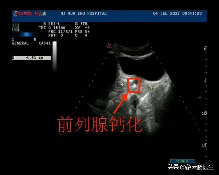 体检发现前列腺钙化,没有什么症状,我该怎么办?会癌变吗?