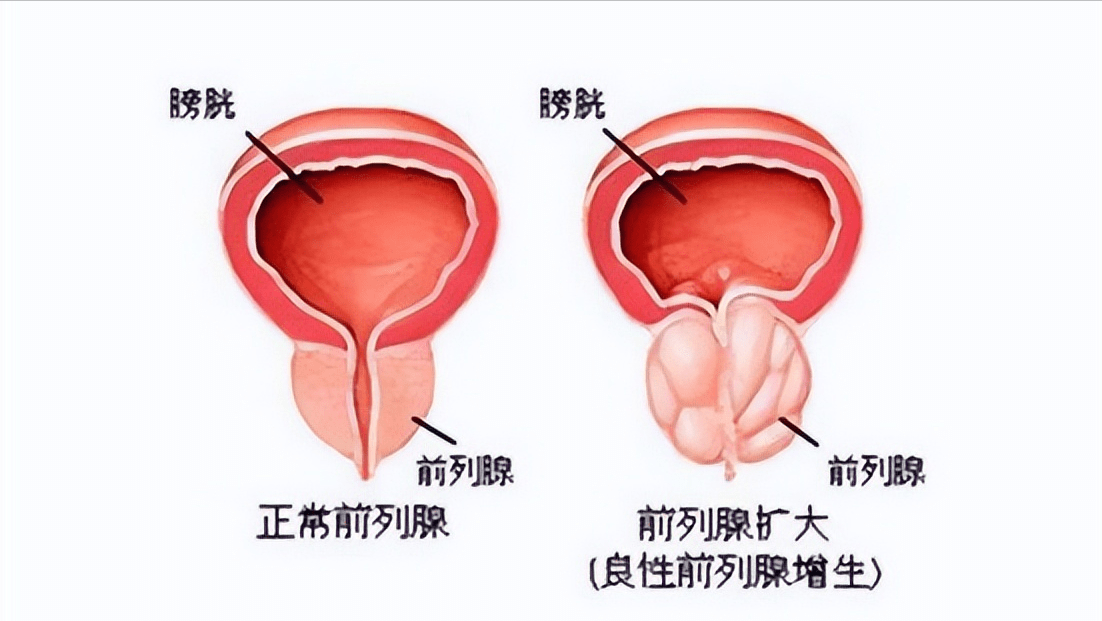 男性得了前列腺肥大怎么办?医生坦言:牢记这几点,有效促进康复_生活_