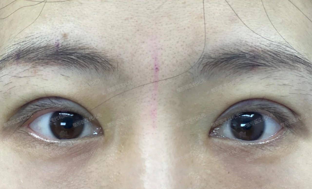 40岁做了全切双眼皮,术前,术后即刻,术后半年,高清照片反馈_手术_自然