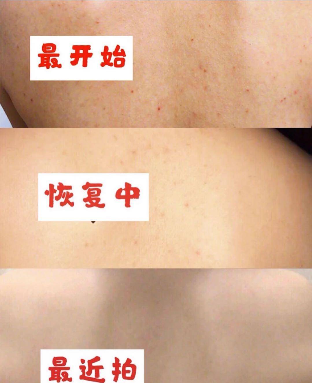 后背的痘痘真的少了很多,那种星星点点的凸起和红点也不见了,皮肤比我