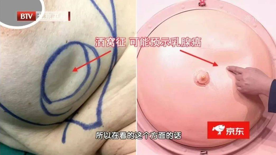 乳腺癌皮肤凹陷图片图片