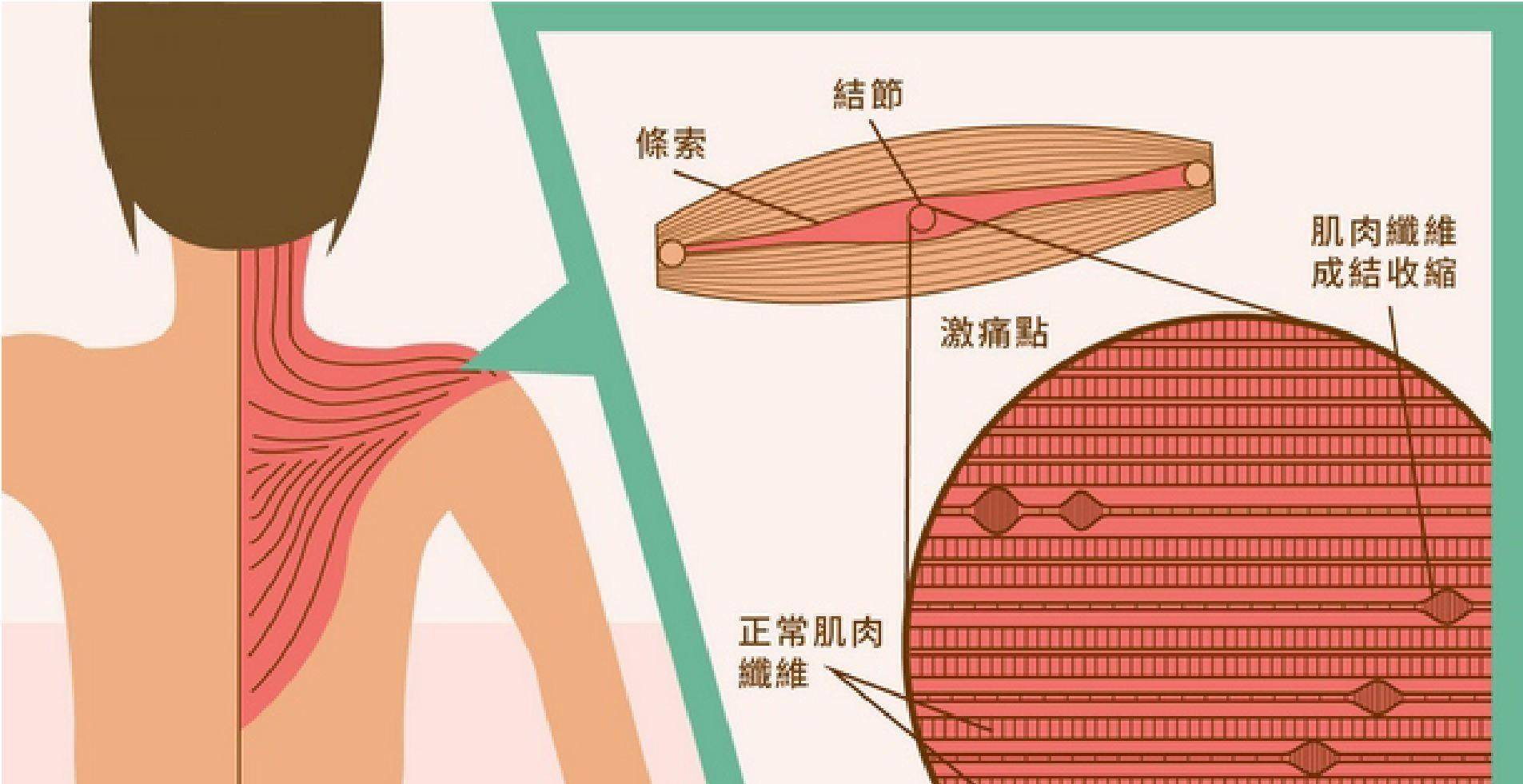 内收肌结节位置示意图图片