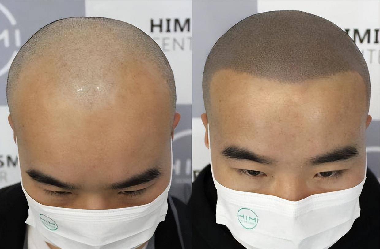 黑米3d纹发:年纪轻轻就秃了,选择纹发会影响当兵吗?