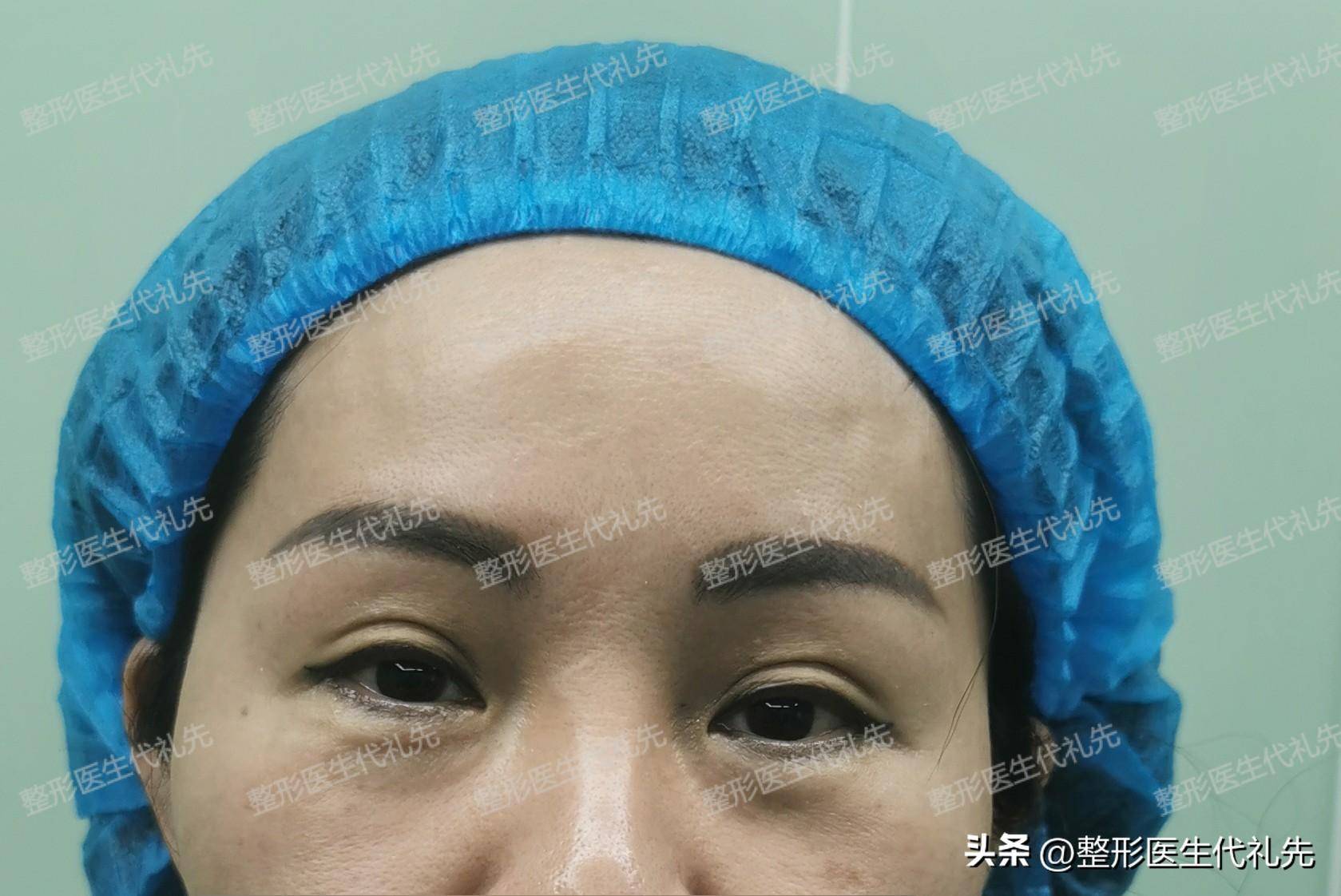 49歲來北京把提眉眼袋手術做了,術後7天眼睛已經恢復的差不多了_醫生