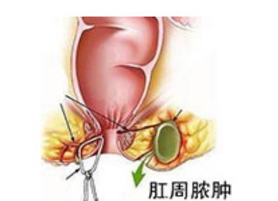 肛周脓肿位置图图片