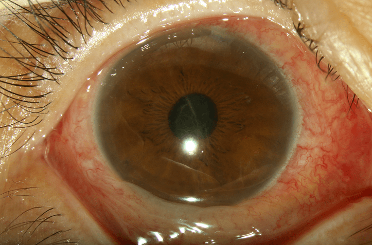葡萄膜炎常起病突然,多为单眼发病,常出现眼红,眼痛,畏光,流泪等症状