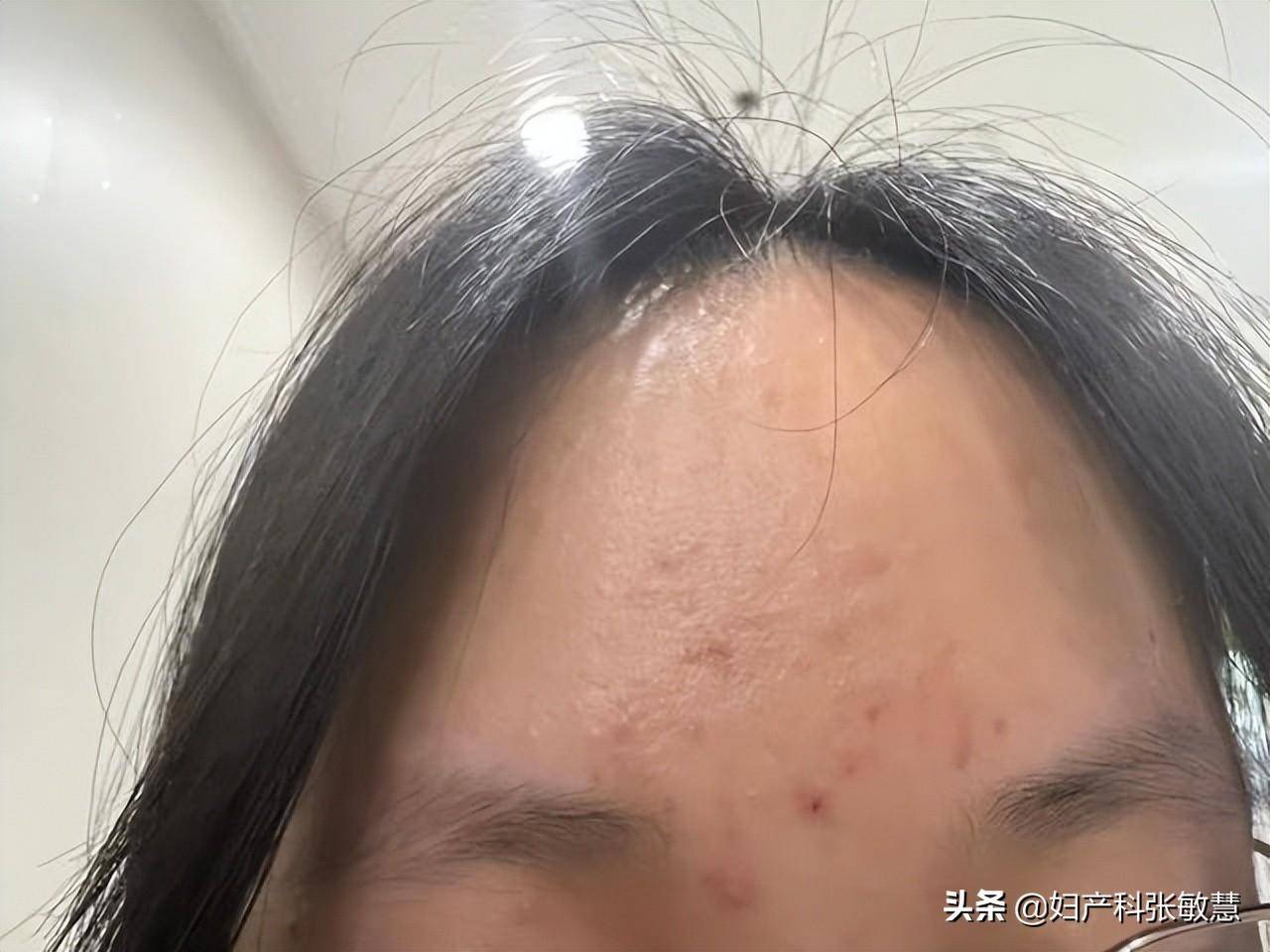 今天来了一个22岁的患者,痤疮很严重,快达到了毁容的地步,体重160斤