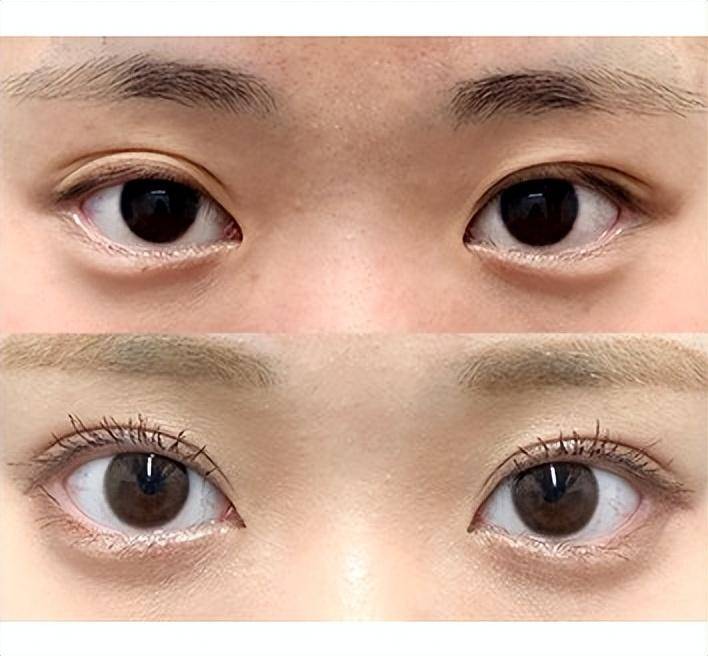 小姐姐四年前做双眼皮,重睑形成粘连,来看修复后的效果怎么样_情况