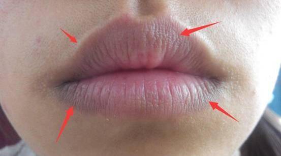 因为,血液黏度较高的部分人随着红细胞的增加,嘴唇出现发绀现象,即使