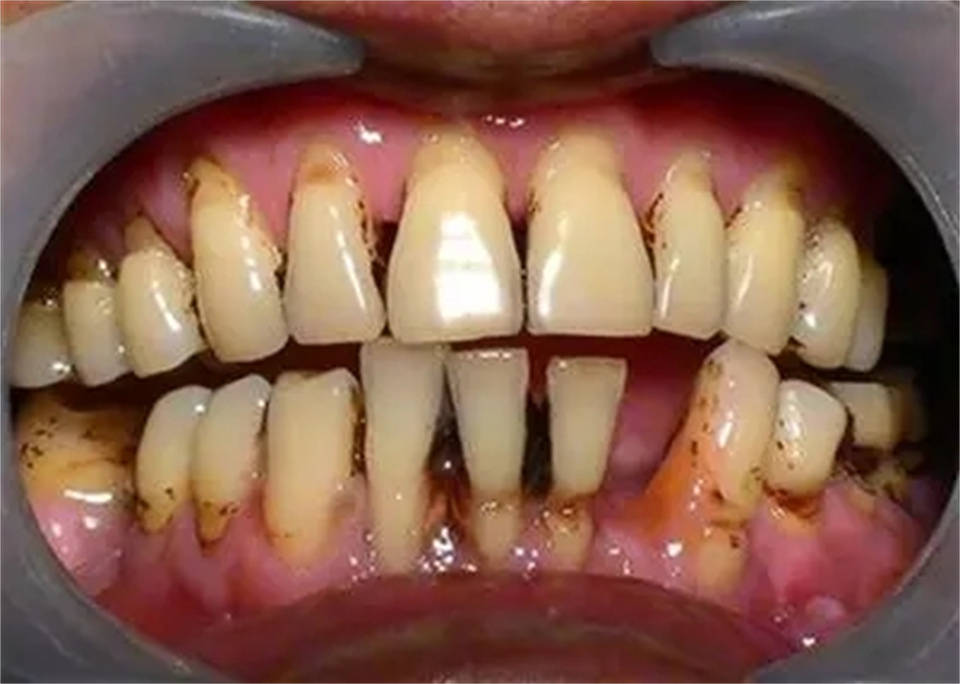 闲时在家这样刷牙,满嘴烟渍牙渍几天就掉!_牙齿_牙膏_牙粉