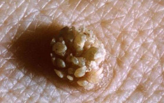 25岁情侣双双消息hpv,医生:无论男女,身上有小"疙瘩",速查hpv_病毒