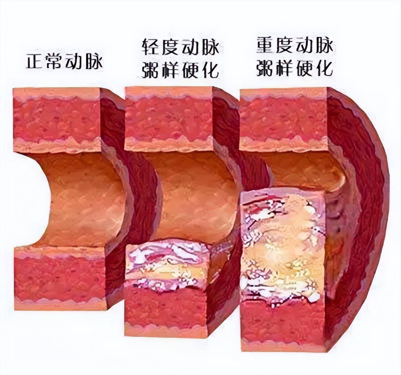 原创            发现甘油三酯高，怎样才能降下来？支招：这3个方法，比较靠谱