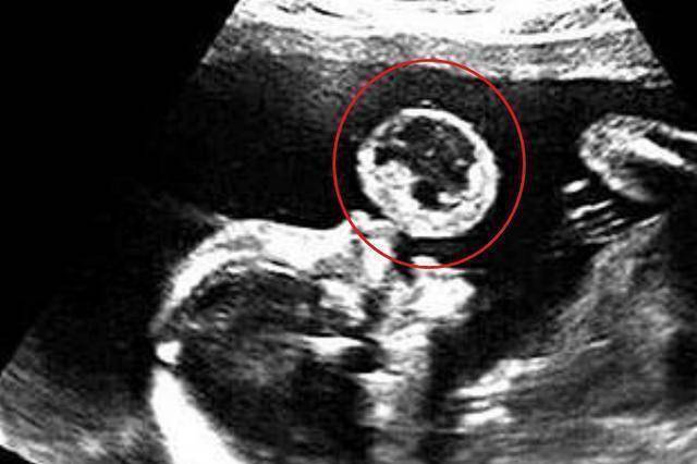 怀孕12周男孩b超图图片