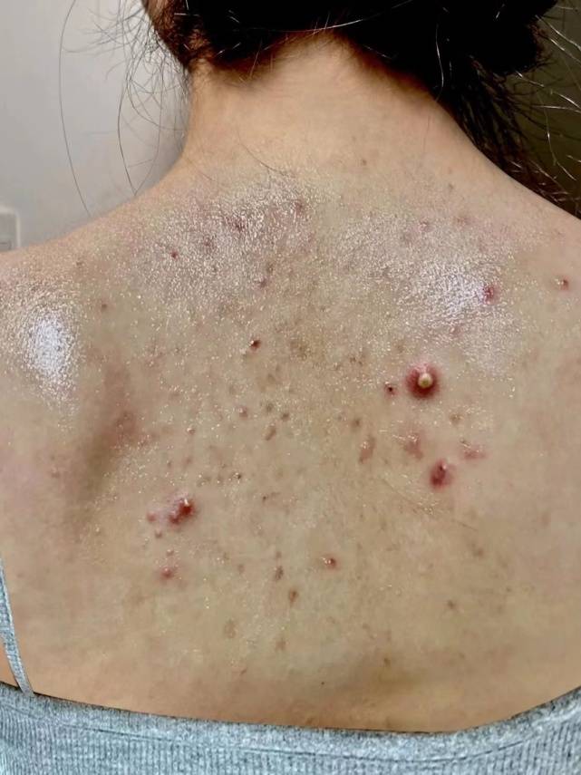 后背痘痘反复长?过来人教你三招!在家一洗螨虫痘刷刷掉!
