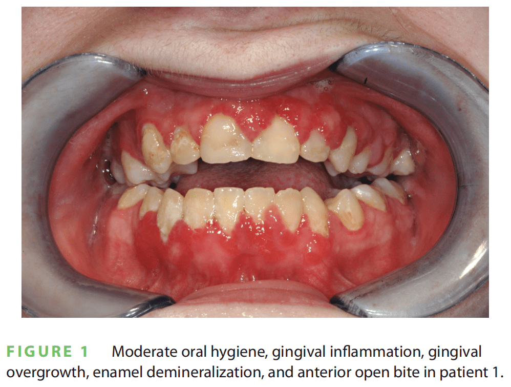pten错构瘤综合征:口腔临床医生如何挽救生命_患者_进行了_治疗
