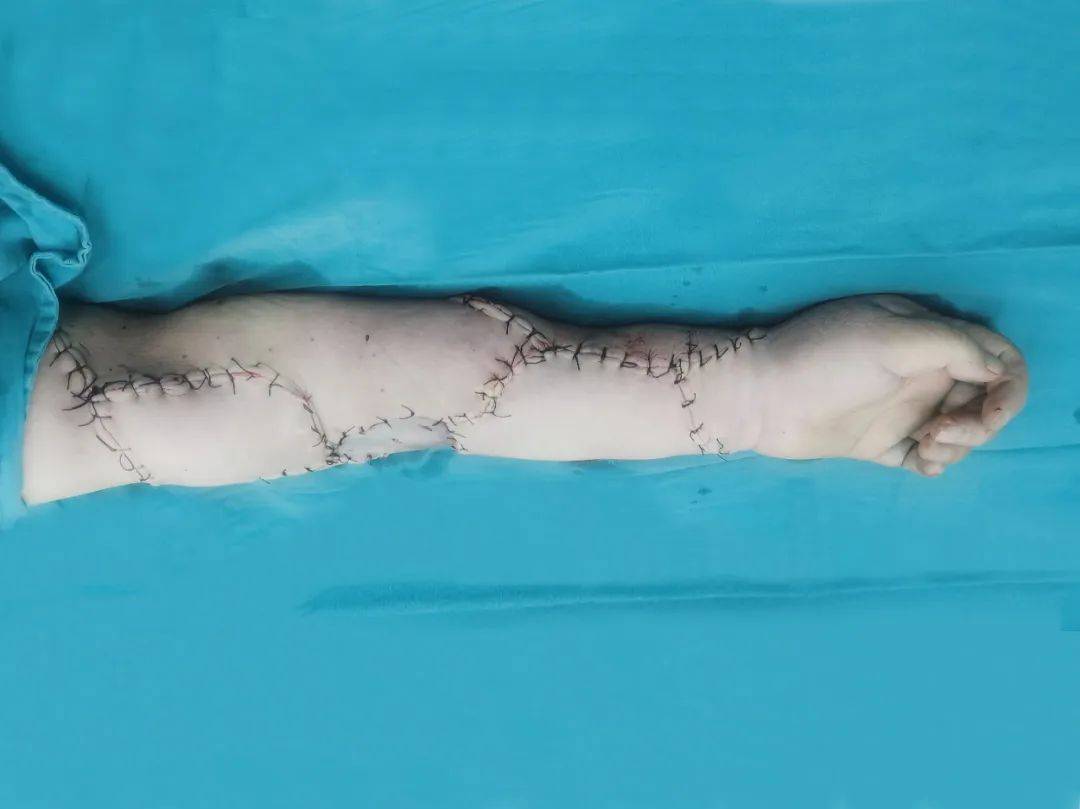 唐举玉教授团队成功治疗左上肢重度淋巴水肿_手术_阿姨