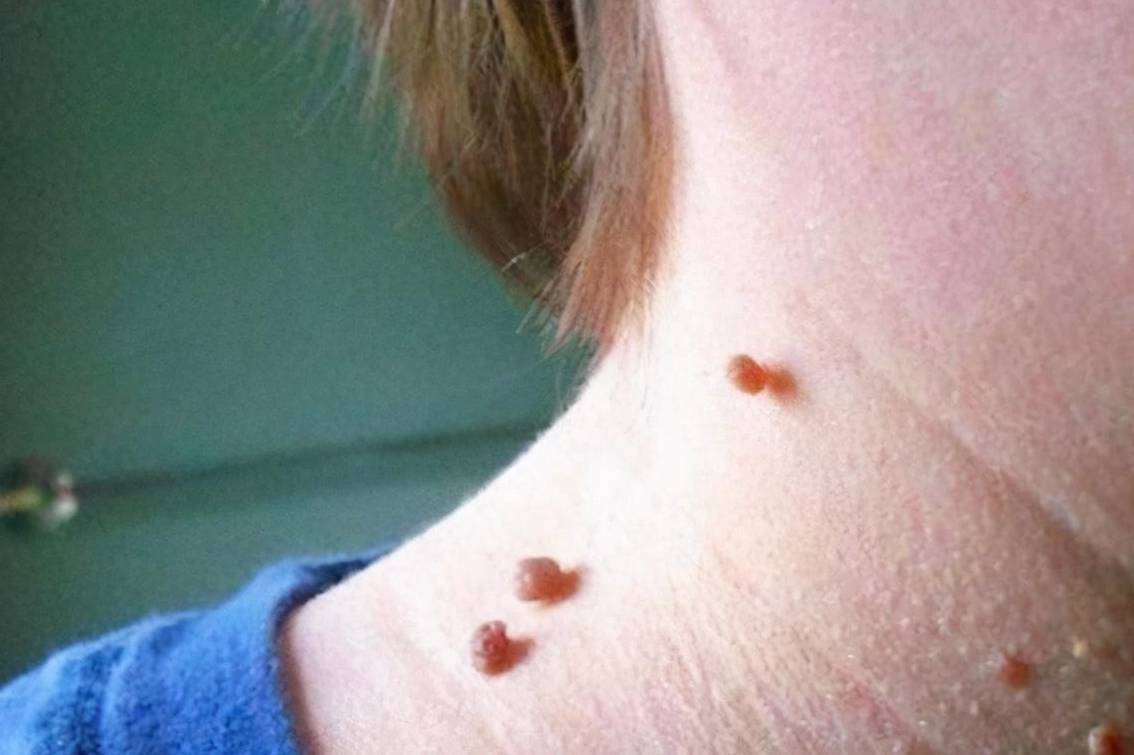 脖子上为何会有"小肉粒",不疼不痒就没事?会癌变吗?