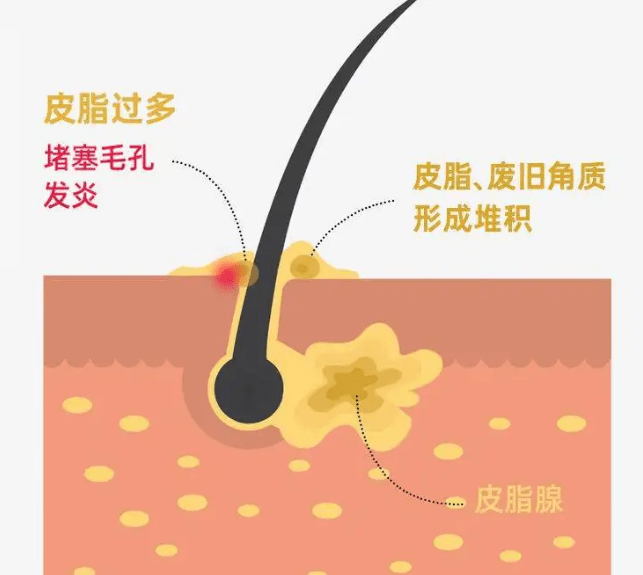 黑米3d纹发:毛囊堵塞有哪些症状,会引起脱发吗?_头皮_油脂_皮脂腺