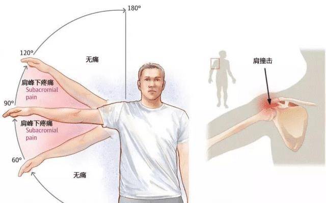 肩关节被动活动图片