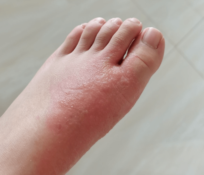 而且脚底板还会脱皮,脱皮的区域会一天天不断扩大,甚至蔓延到了脚趾缝