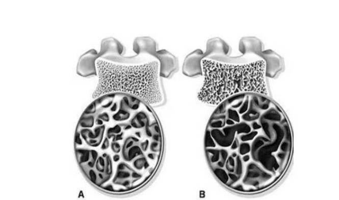 正常人的椎體由骨小梁縱橫交錯形成椎體的初級結構,起主要的支撐作用