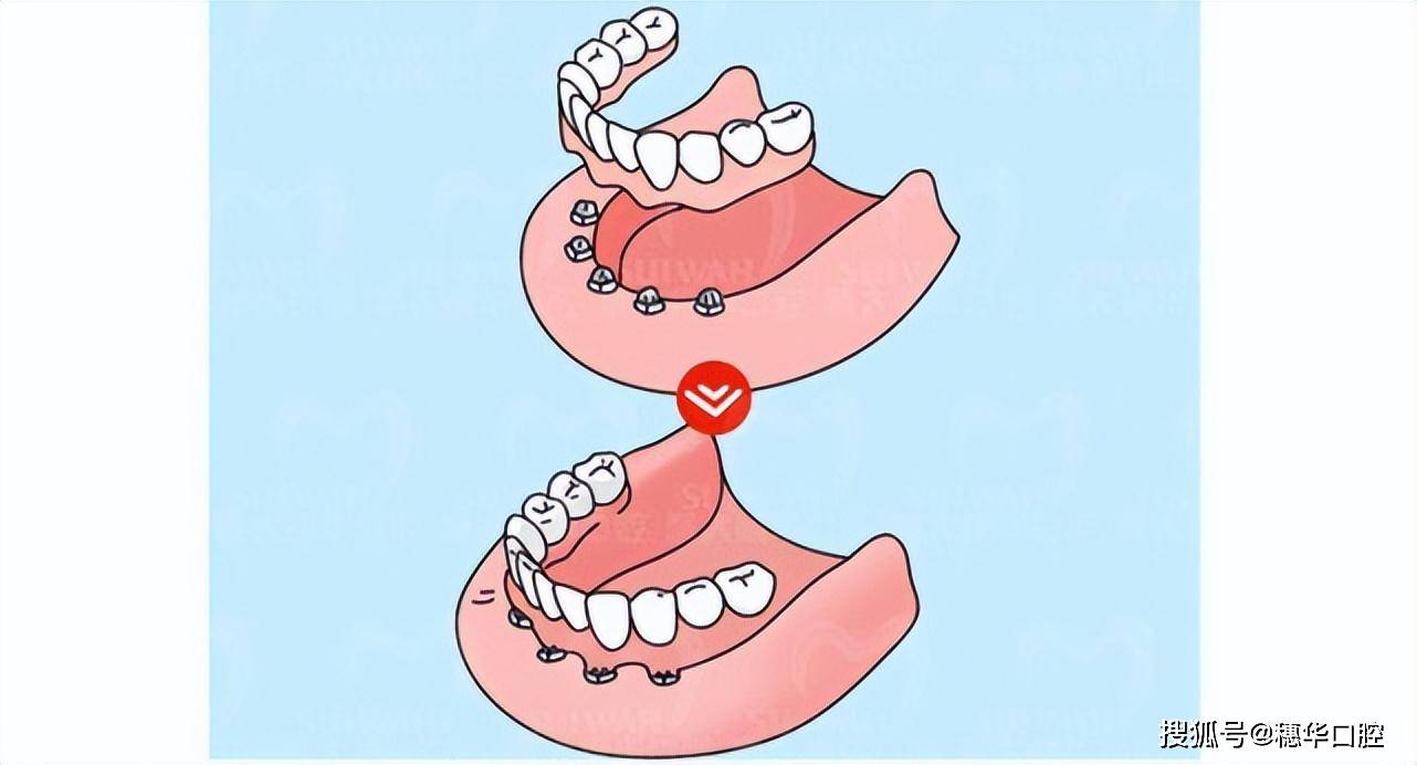 全口无牙戴假牙就好了,还有必要种牙吗?_种植_活动_口腔