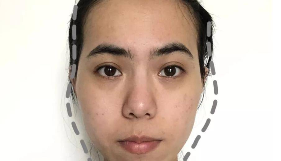 脸型不好看?打了玻尿酸,太阳穴饱满,下巴圆润,小v脸也有了!