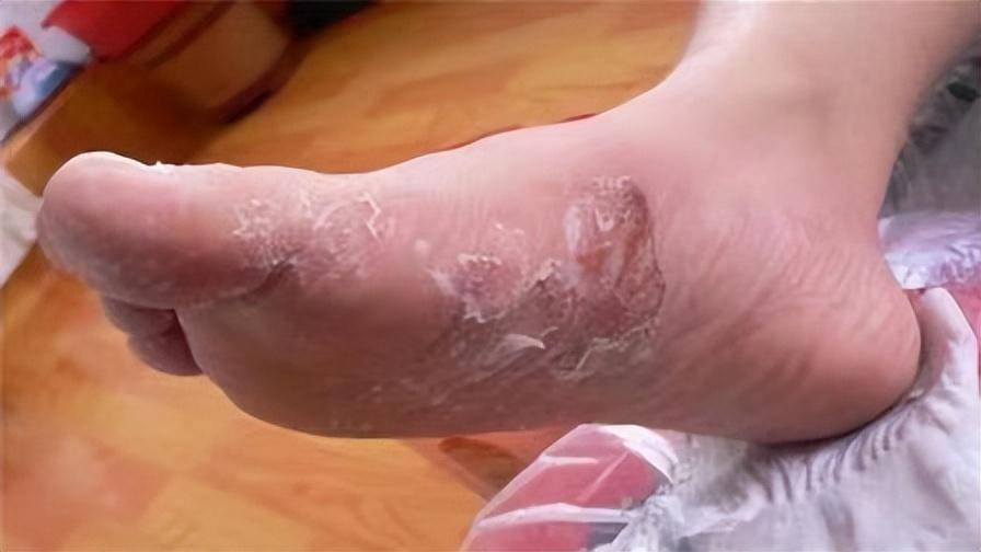 过来人自用治疗指南!顽固脚气在家去除!_效果_物理疗法_过程