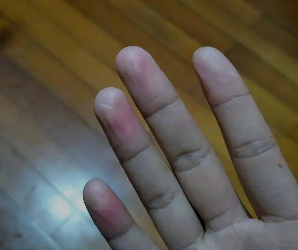 手指头会有泛白的情况,不再按压之后,手指头会迅速恢复原来的血色