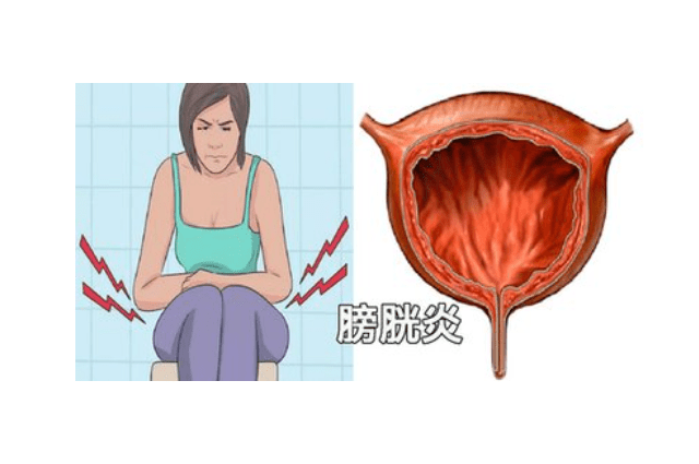 急性膀胱炎的症状 来自搜狐网